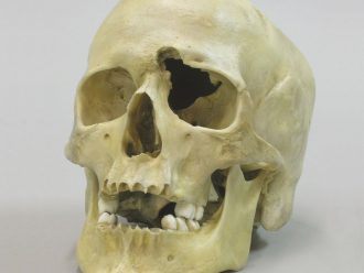 Human Male Skull with a .32-Caliber Gunshot Wound