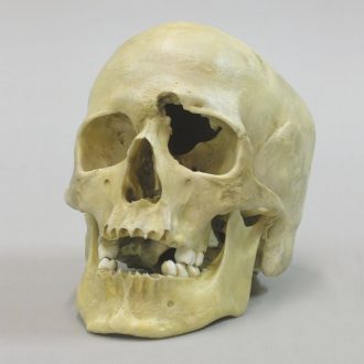 Human Male Skull with a .32-Caliber Gunshot Wound
