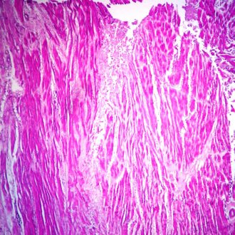 Myocardial Infarction, Sec. Microscope Slide