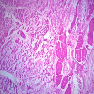 Human Myocardial Infarct, Old, sec. 7 µm, H&E Microscope Slide