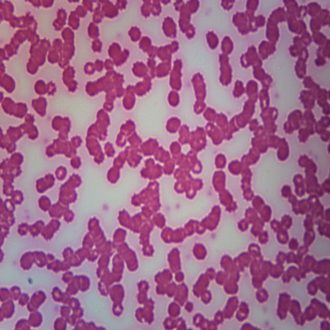 Human Eosinophilia, smear Microscope Slide