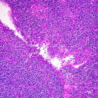 Human Hodgkin's Granuloma, smear Microscope Slide