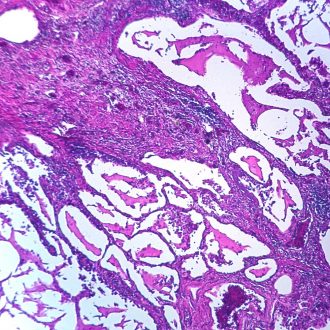 Human Pulmonary Edema, sec. 7 µm, H&E Microscope Slide