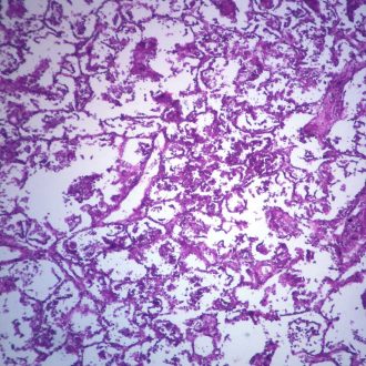 Human Bronchopneumonia, sec. 7 µm H&E Microscope Slide