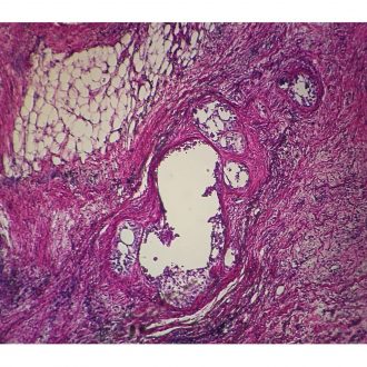 Human Adenocarcinoma of Lung, sec. 7 µm H&E Microscope Slide