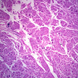 Human Pulmonary Emphysema, sec. 7 µm H&E Microscope Slide
