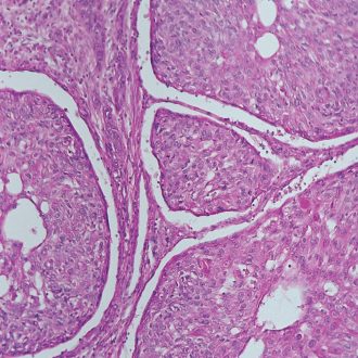 Human Carcinoma of Esophagus, sec. 7 µm, H&E Microscope Slide