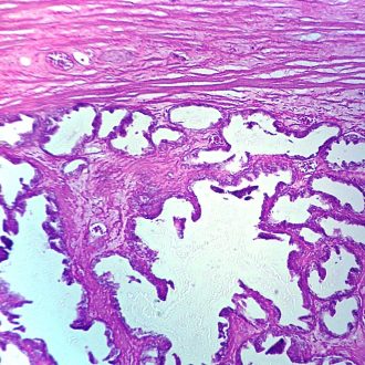 Human Carcinoma of Prostate, sec. 7 µm H&E Microscope Slide