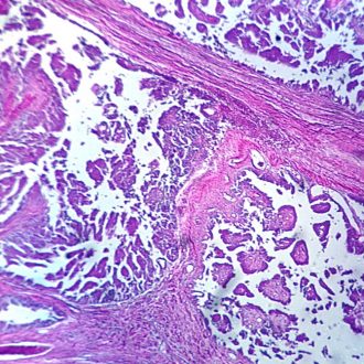 Human Adenocarcinoma of Ovary, sec. 7 µm H&E Microscope Slide