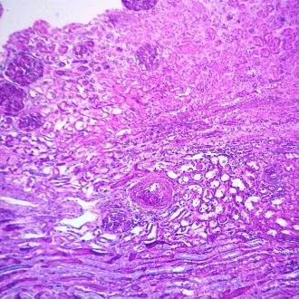 Human Endometriosis of Ovary, sec. 7 µm H&E Microscope Slide