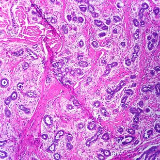 Fibroadenoma, Breast, Microscope Slide