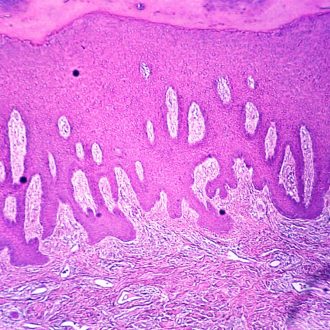 Severe Frostbite, Microscope Slide