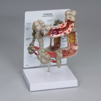 GPI Anatomicals® Human Colon Pathology Model