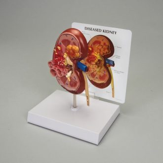 GPI Anatomicals® Human Kidney Pathology Model