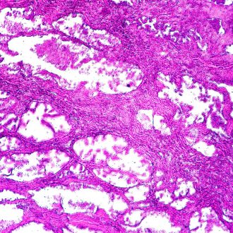Benign Prostatic Hyperplasia, Microscope Slide