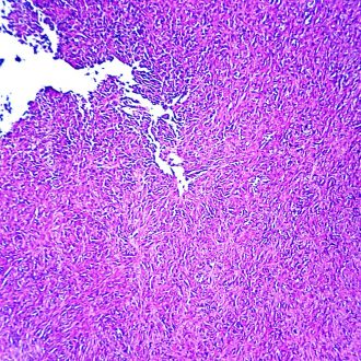 Sarcoma, Uterus, Microscope Slide