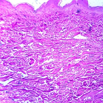 Rocky Mountain Spotted Fever, Skin, section Microscope Slide